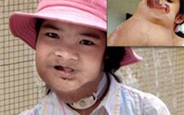 Nụ cười trở lại với bé gái có khối u khổng lồ